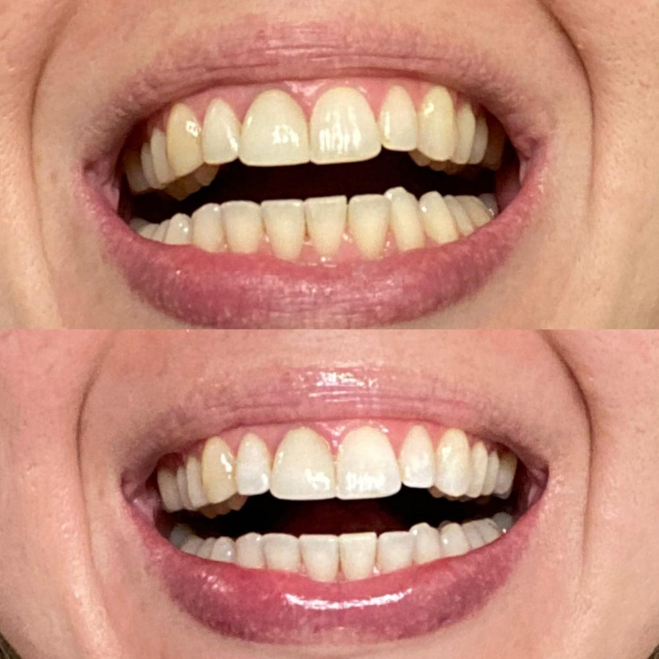 Echoa™ Teeth Whitening Powder - Buy 1, Get 1 Free