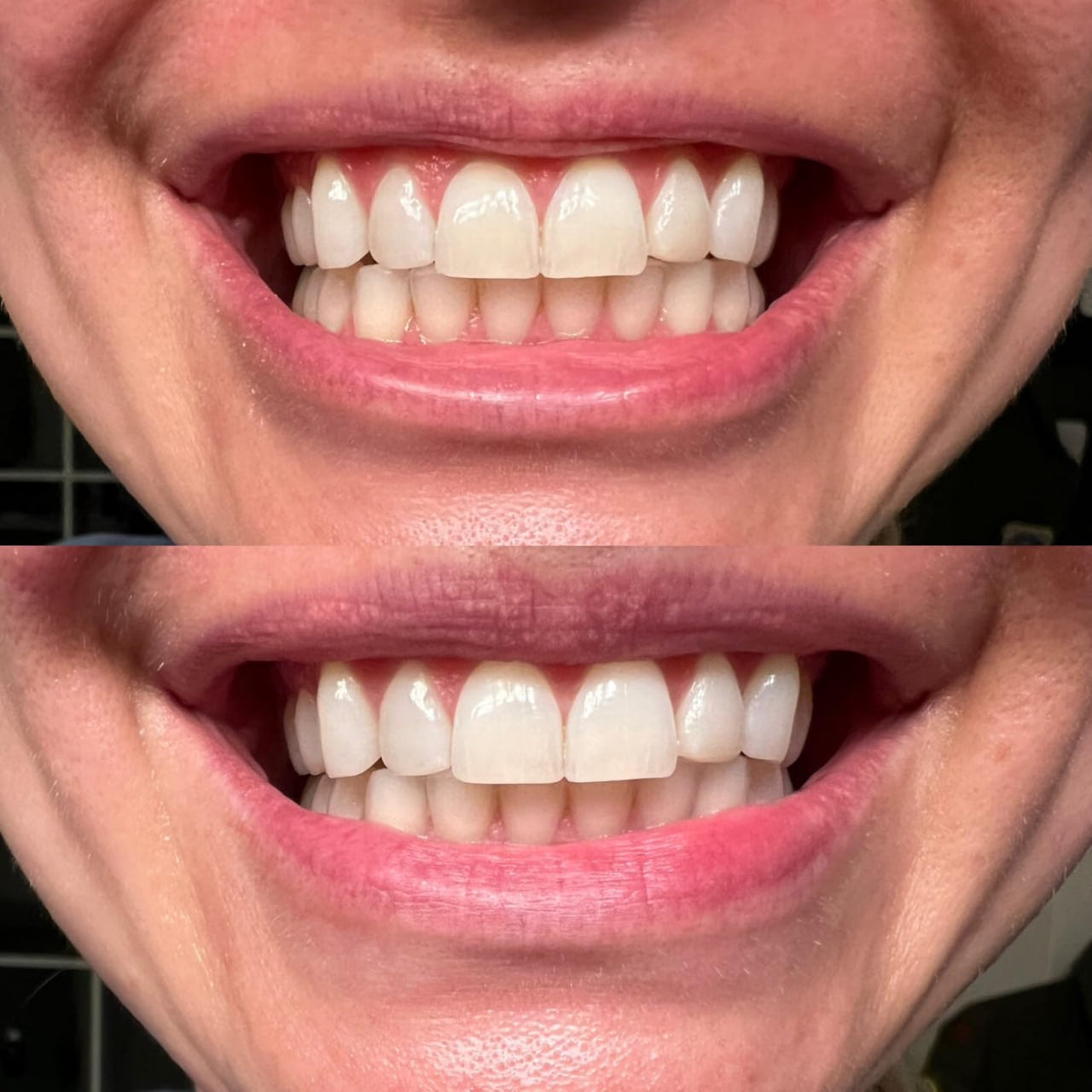 Echoa™ Teeth Whitening Powder - Buy 1, Get 1 Free